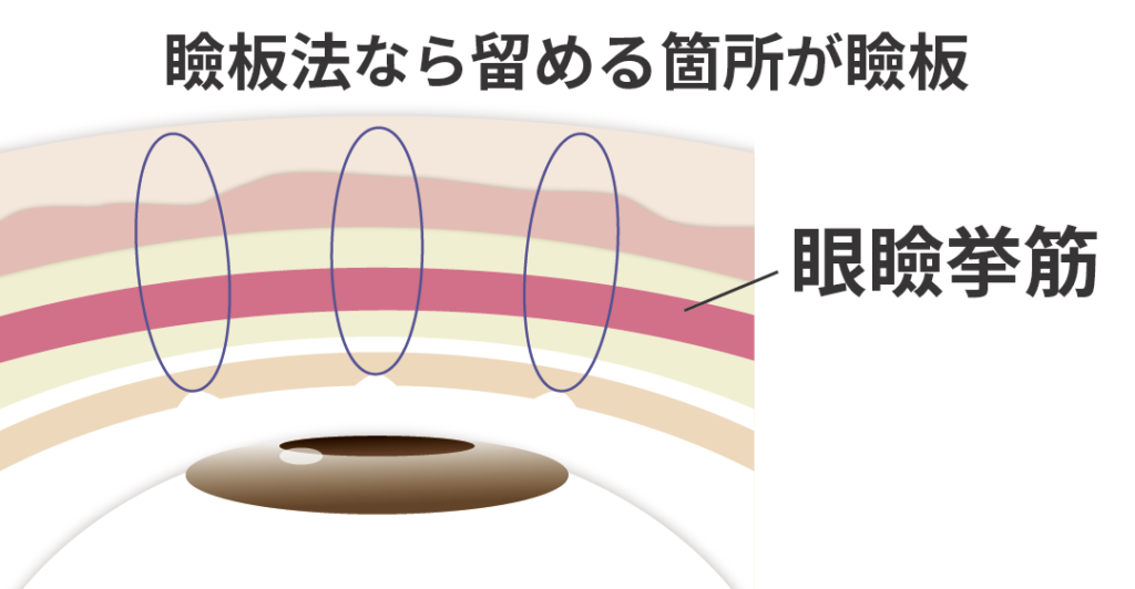 挙筋法による二重整形を解説する図解|まぶたの皮膚と挙筋を糸で固定する埋没法の特徴・メリット・デメリット