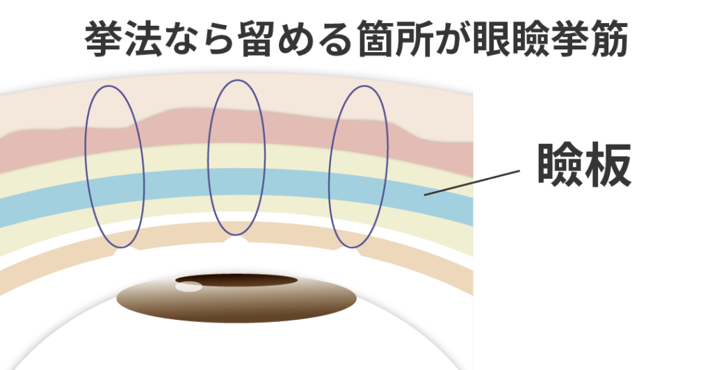 瞼板法による二重整形を解説する図解|まぶたの皮膚と瞼板を糸で固定する埋没法の特徴・メリット・デメリット