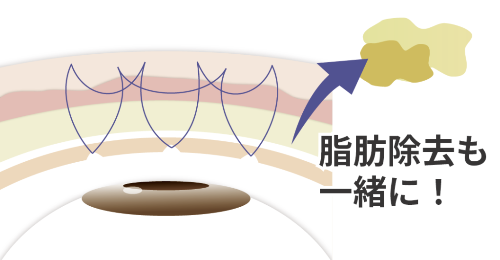 自然癒着法による二重整形の図解|小切開と糸による埋没で自然な二重ラインを長期間キープできる術式