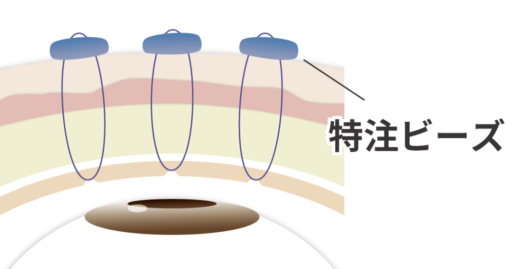 ビーズ法による特殊な埋没法の図解|まぶたに小さなビーズを縫合して強固な二重ラインを形成する施術イメージ