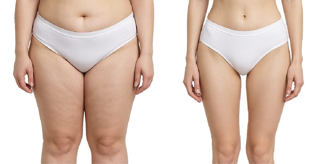 太ももとお尻の脂肪吸引ビフォーアフター画像|下半身痩せ・美尻形成・脚長効果を目指す美容整形施術例